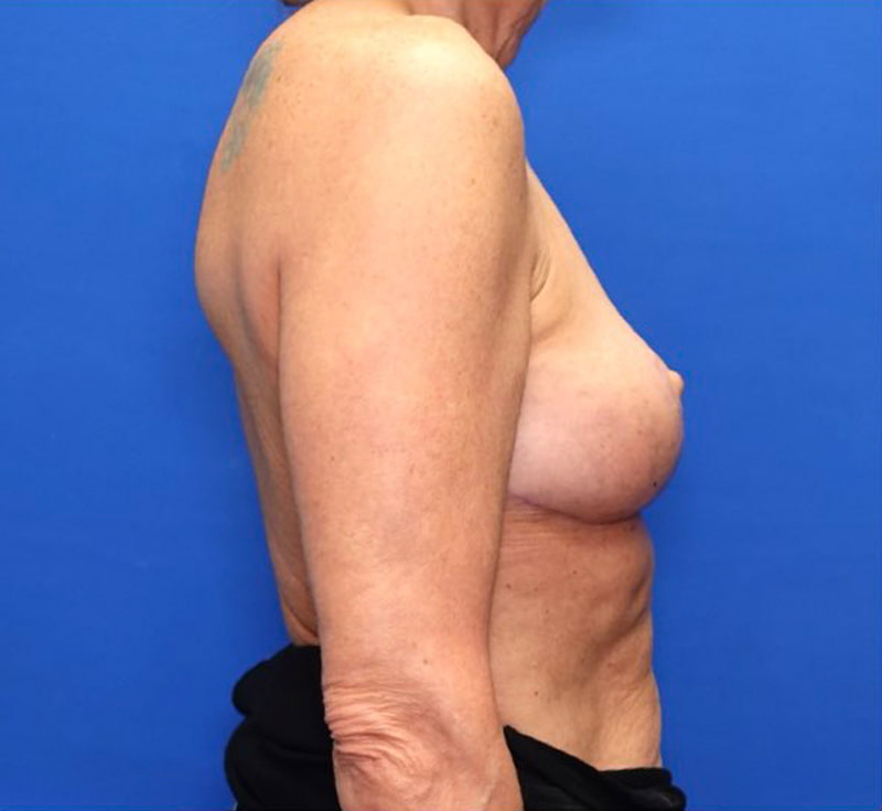 Breast Implant Removal Before & After Photo