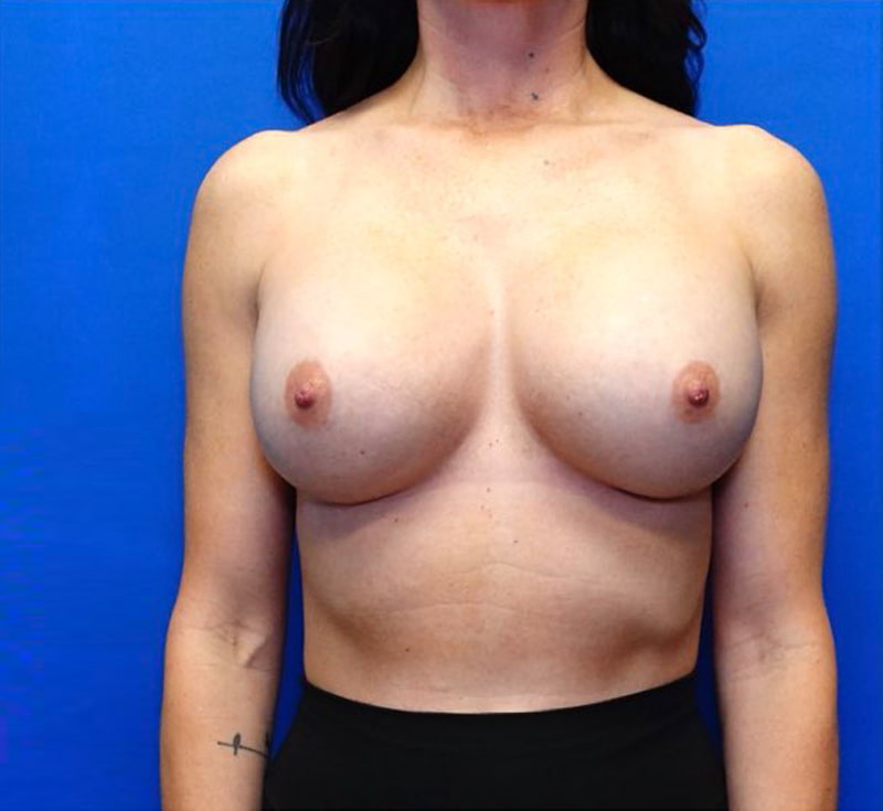 Breast Implant Removal Before & After Photo
