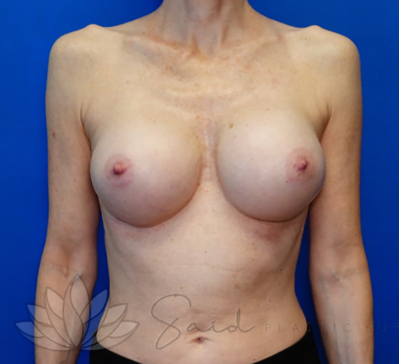 Breast Implant Revision Before & After Photo