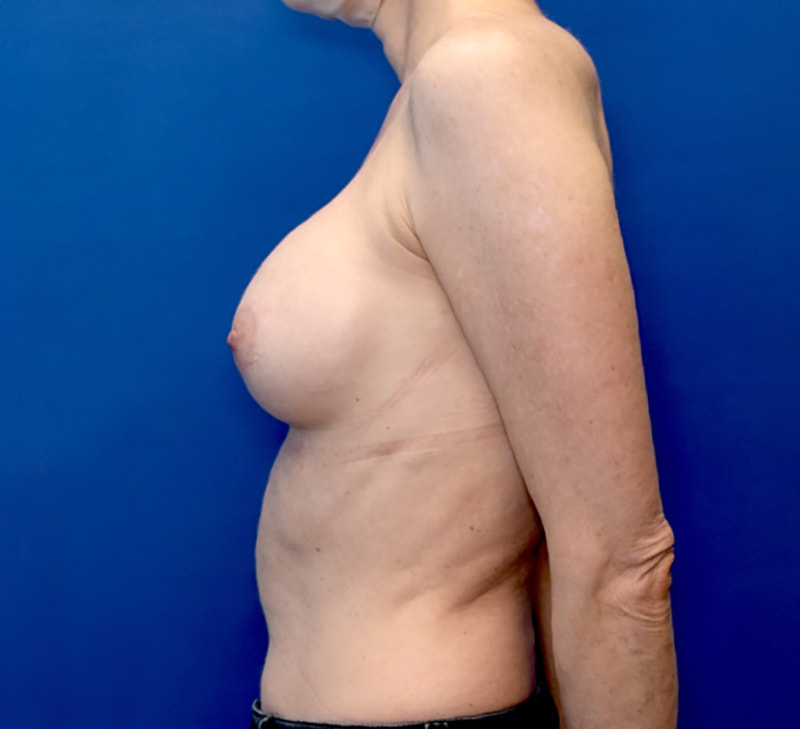 Breast Implant Revision Before & After Photo