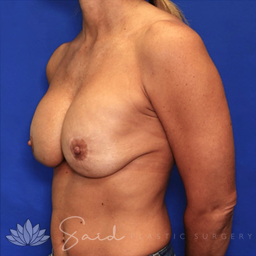 Breast Implant Revision Before & After Photo