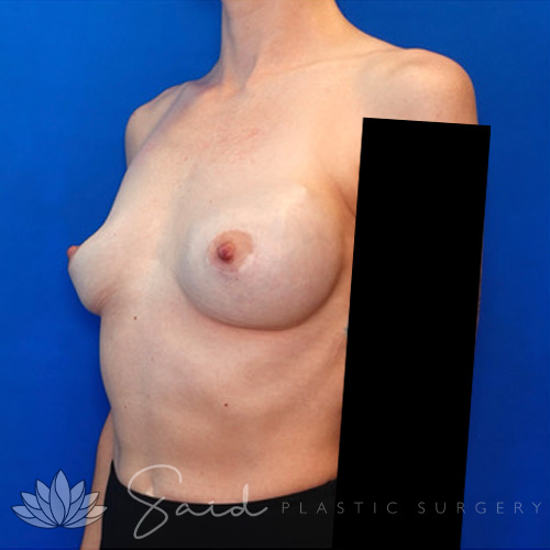 Breast Implant Revision Before & After Photo