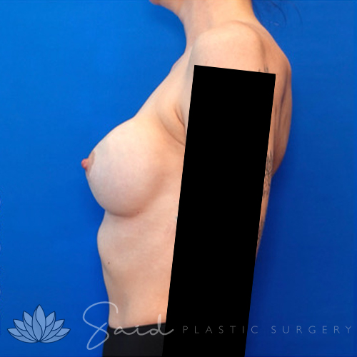 Breast Implant Revision Before & After Photo