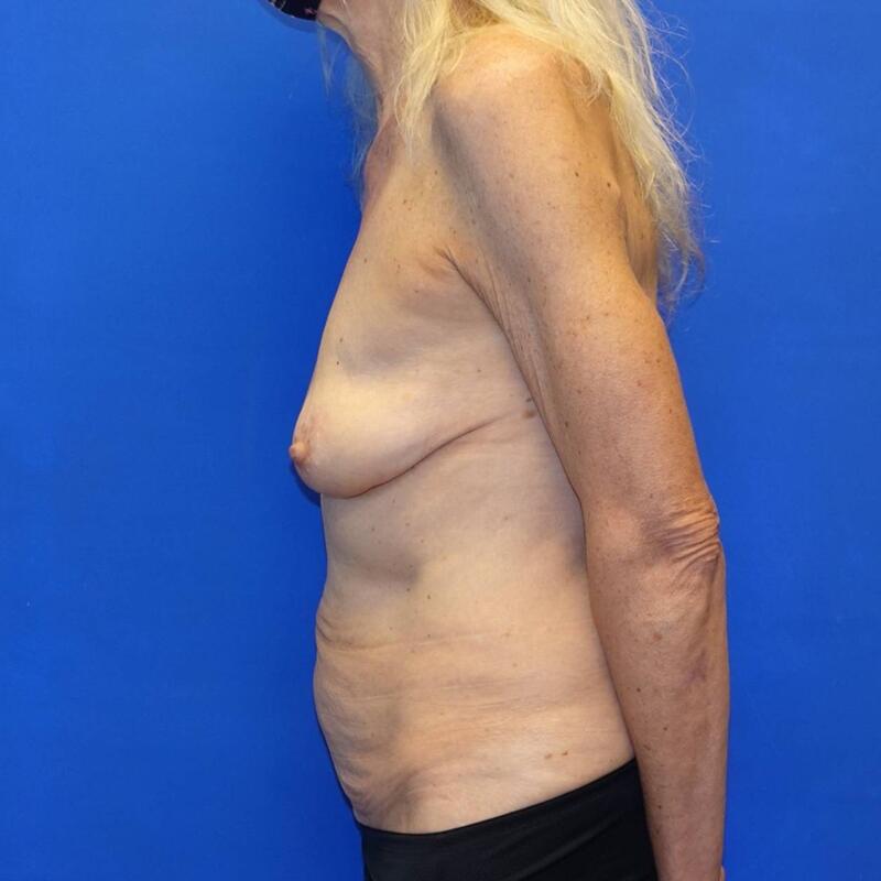 Breast Lift Before & After Photo