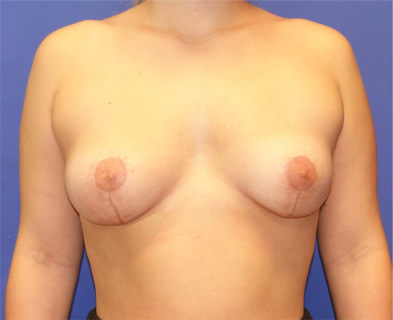 Breast Lift Before & After Photo