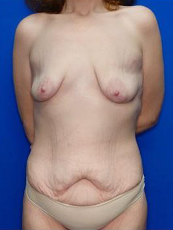 Breast Lift Before & After Photo