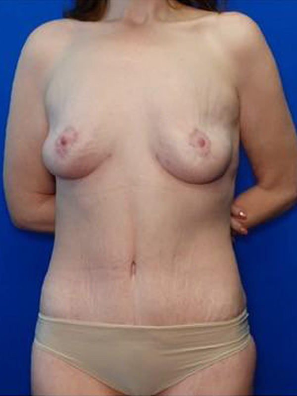 Breast Lift Before & After Photo