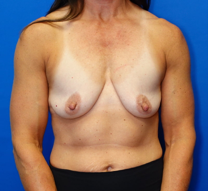 Breast Lift Before & After Photo