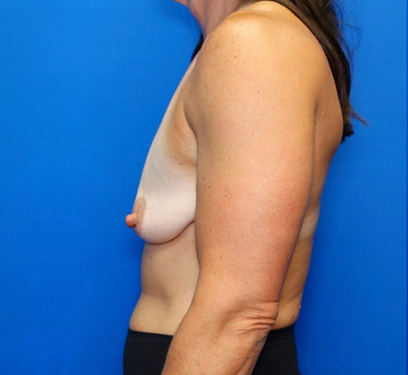 Breast Lift Before & After Photo