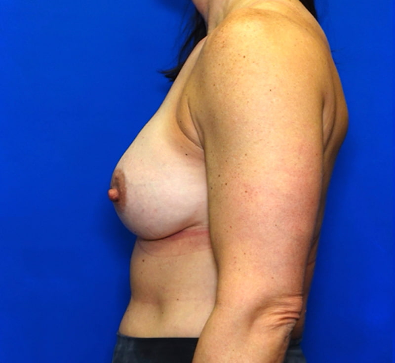 Breast Lift Before & After Photo