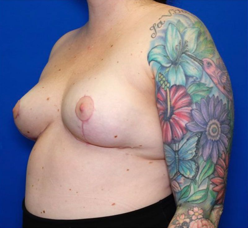 Breast Lift Before & After Photo