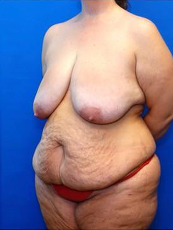 Breast Reduction Before & After Photo