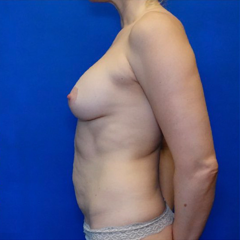 Fat Transfer Breast Augmentation Before & After Photo