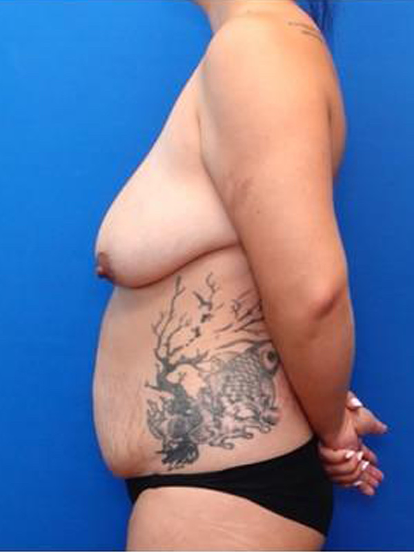 Fat Transfer Breast Augmentation Before & After Photo