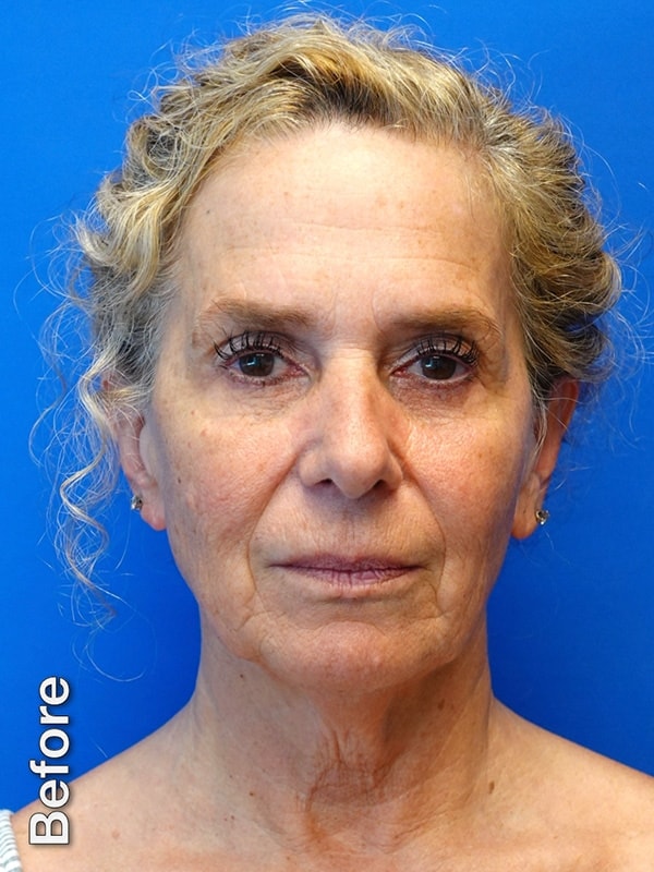 Fat Transfer to Cheeks Before & After Photo
