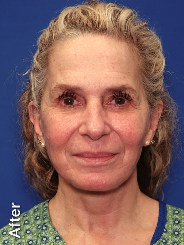 Fat Transfer to Cheeks Before & After Photo