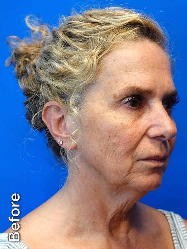 Fat Transfer to Cheeks Before & After Photo
