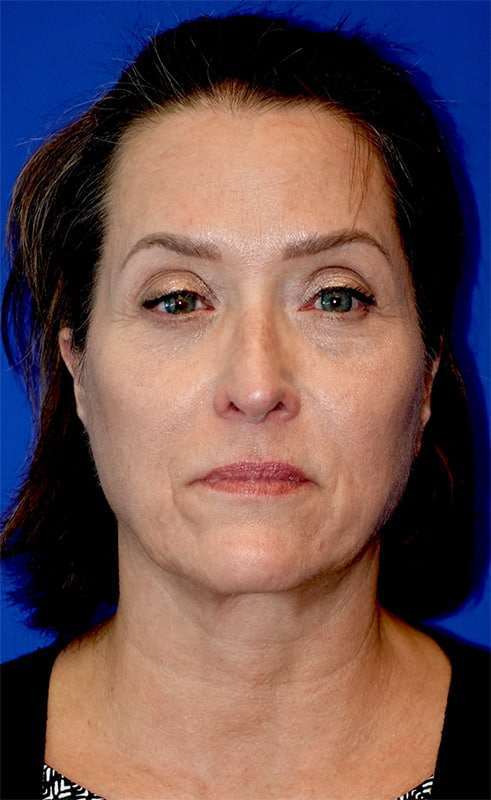 Lower Blepharoplasty Before & After Photo