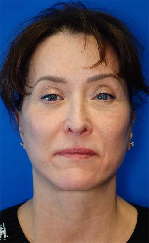 Lower Blepharoplasty Before & After Photo