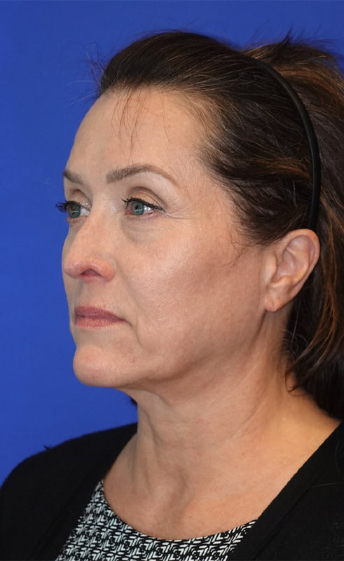 Lower Blepharoplasty Before & After Photo