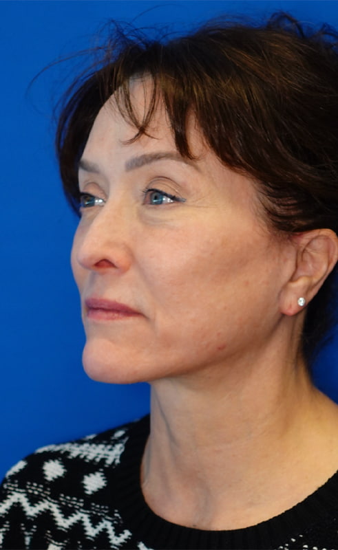 Lower Blepharoplasty Before & After Photo