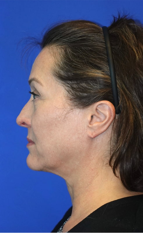 Lower Blepharoplasty Before & After Photo