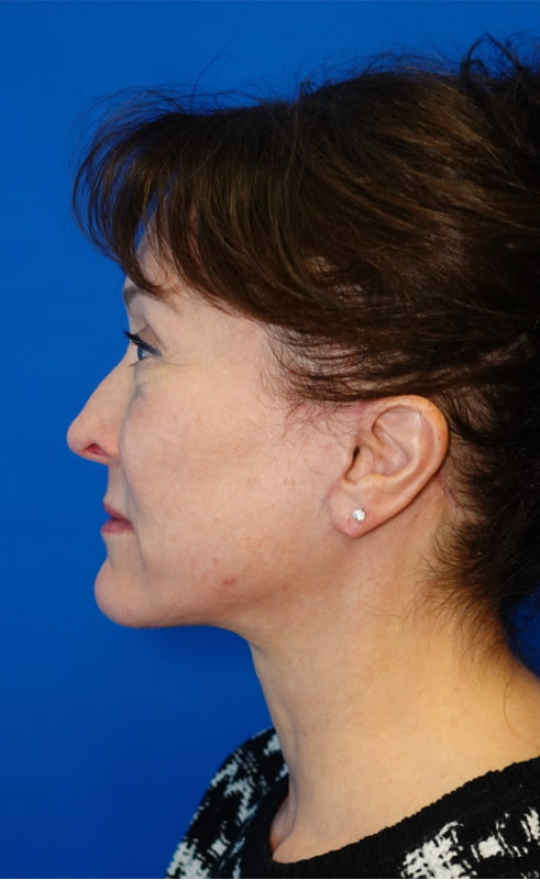 Lower Blepharoplasty Before & After Photo