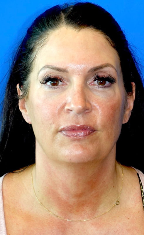 Lower Face & Neck Lift Before & After Photo
