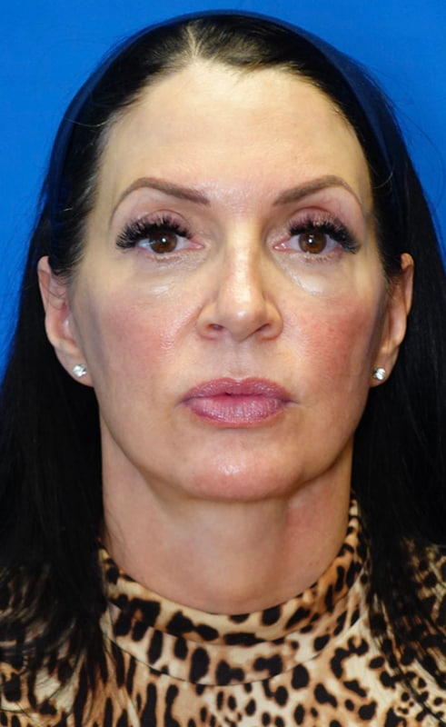 Lower Face & Neck Lift Before & After Photo