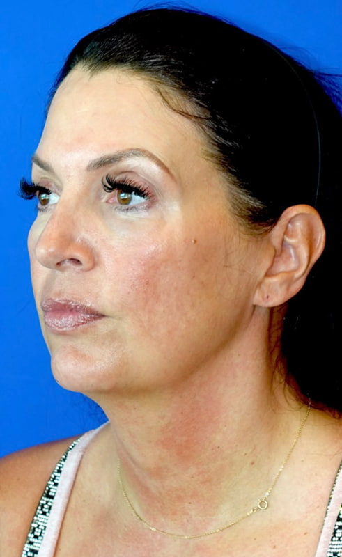 Lower Face & Neck Lift Before & After Photo