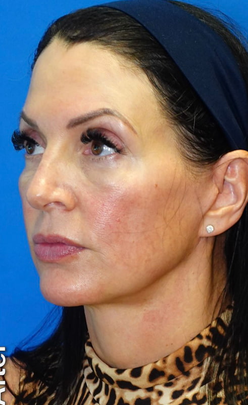 Lower Face & Neck Lift Before & After Photo