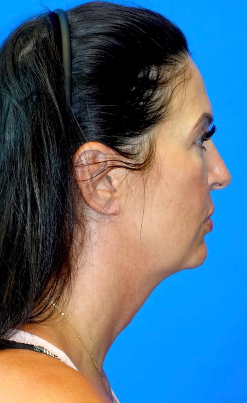 Lower Face & Neck Lift Before & After Photo