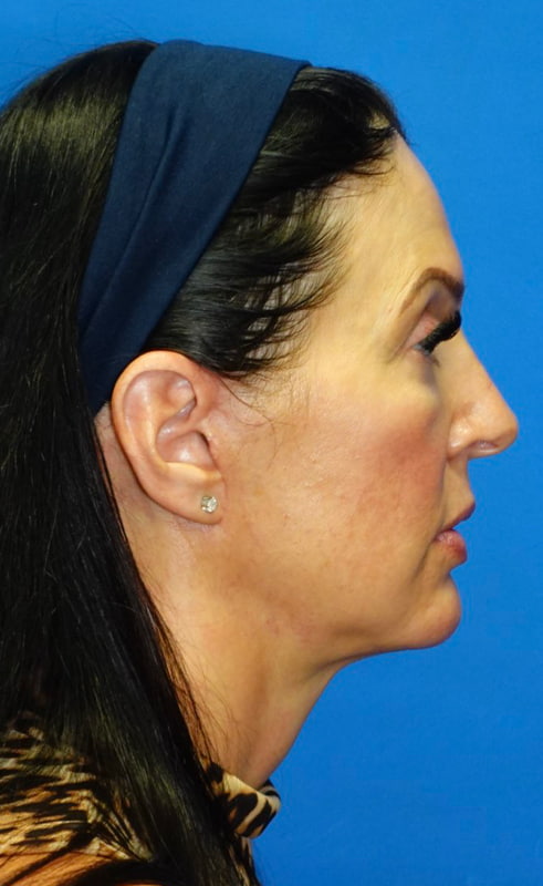 Lower Face & Neck Lift Before & After Photo
