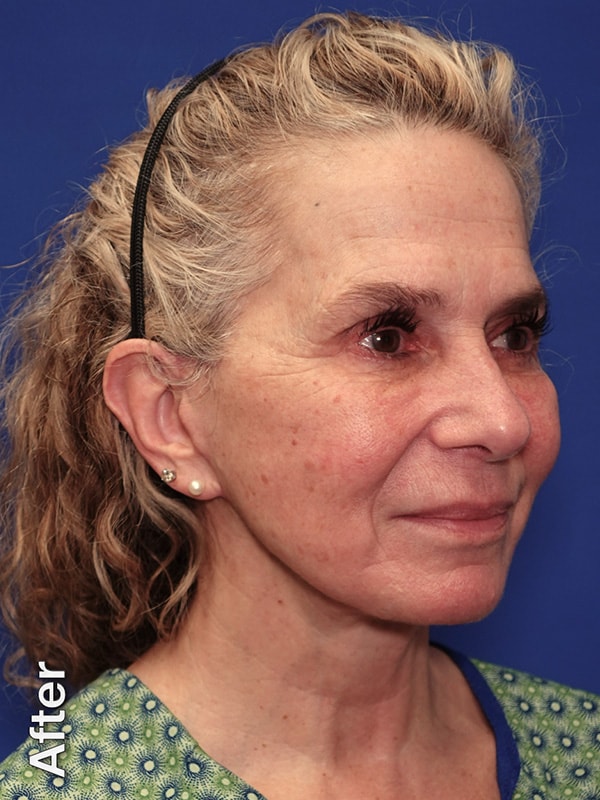 Necklift Before & After Photo