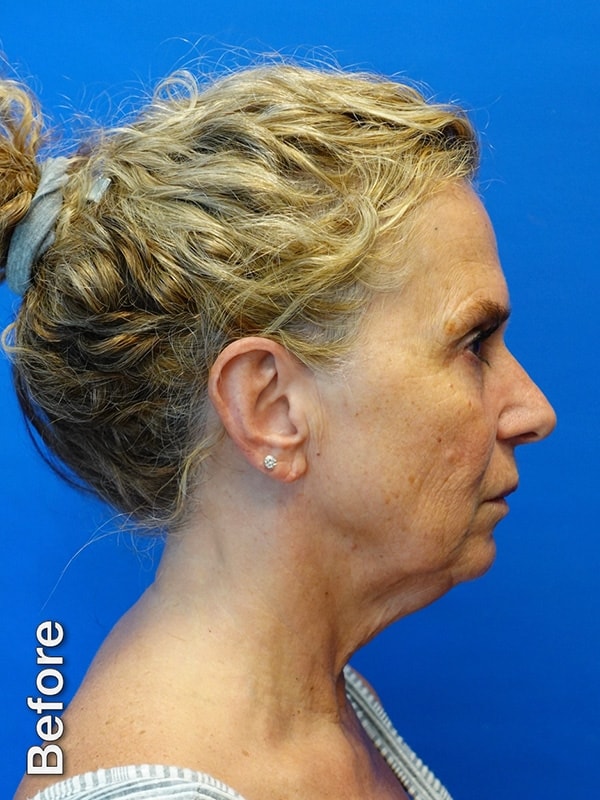 Necklift Before & After Photo