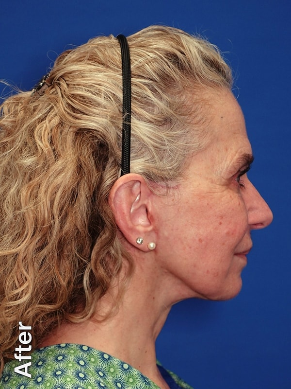 Necklift Before & After Photo