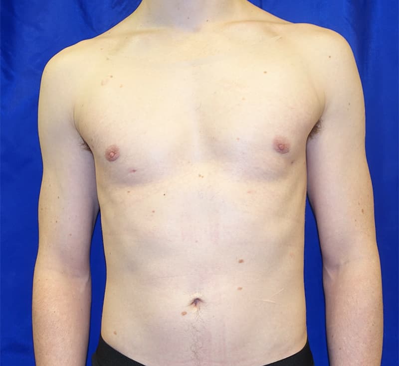 Gynecomastia Before & After Photo