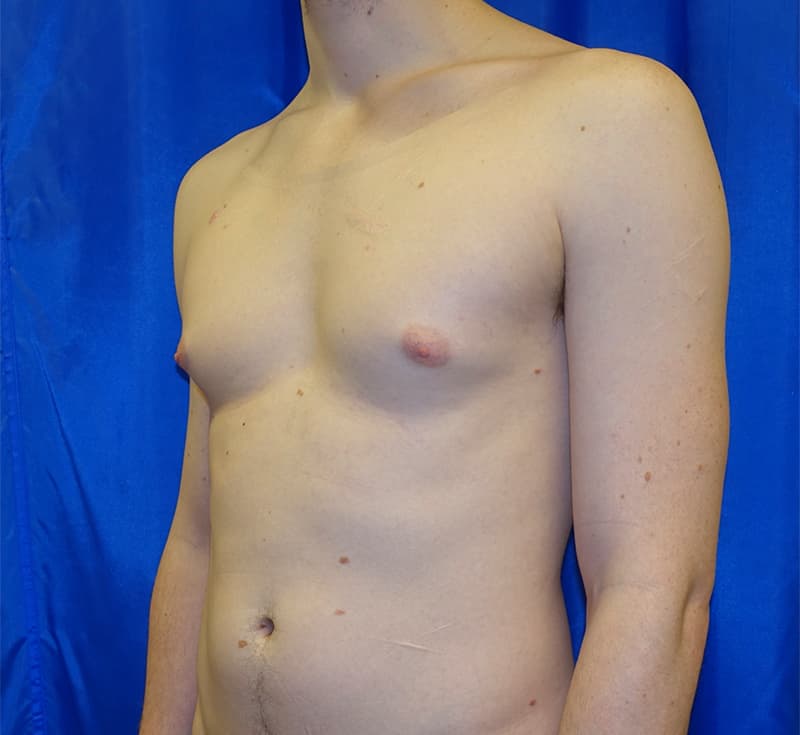 Gynecomastia Before & After Photo