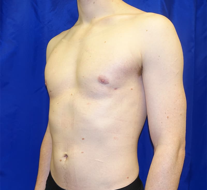 Gynecomastia Before & After Photo