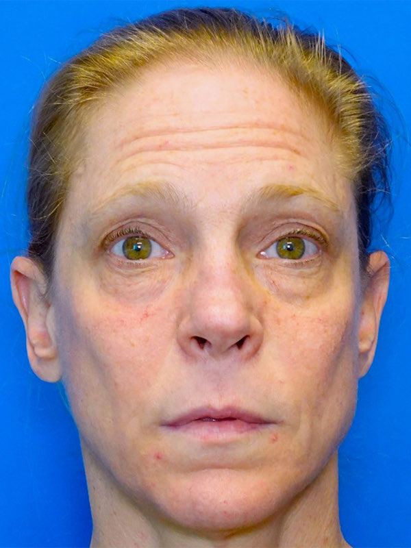 Fat Transfer to Tear Troughs Before & After Photo