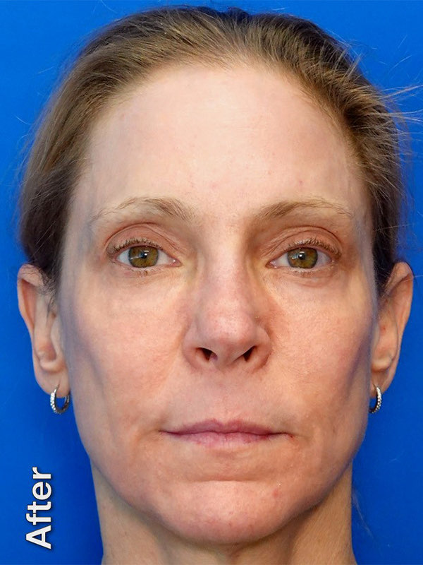 Fat Transfer to Tear Troughs Before & After Photo