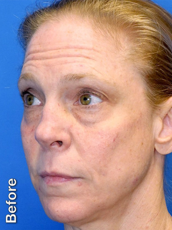 Fat Transfer to Tear Troughs Before & After Photo