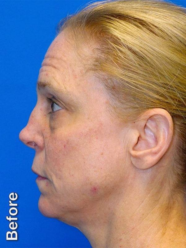 Fat Transfer to Tear Troughs Before & After Photo