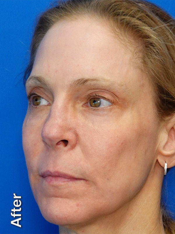 Fat Transfer to Tear Troughs Before & After Photo