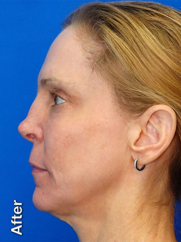 Fat Transfer to Tear Troughs Before & After Photo