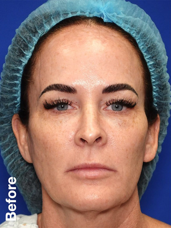 Peel Before & After Photo