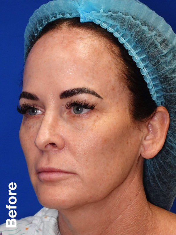 Peel Before & After Photo