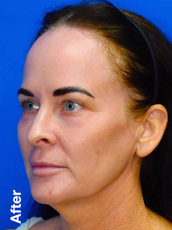 Peel Before & After Photo