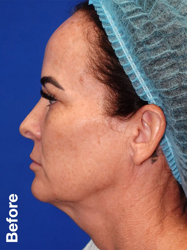 Peel Before & After Photo