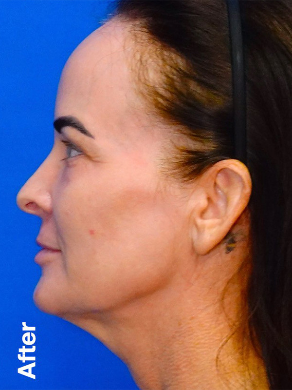 Peel Before & After Photo